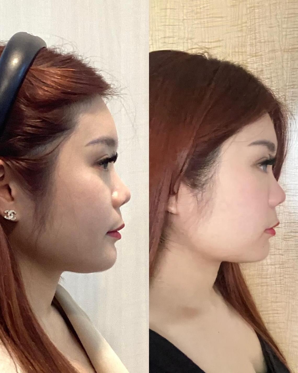 More younger Singaporeans are getting Botox and collagen shots. How effective and safe are they?