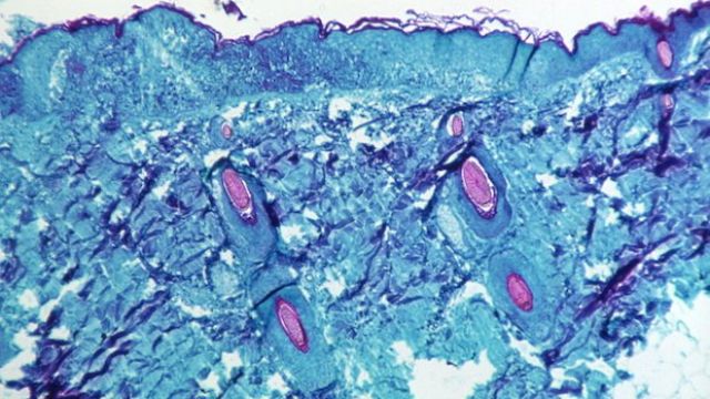 2022-05-21-Skin-tissue-of-monkey-with-monkeypox.jpeg