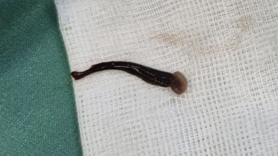 Leech removed from 3-year-old girl’s nostril in Thailand’s Chiang Mai