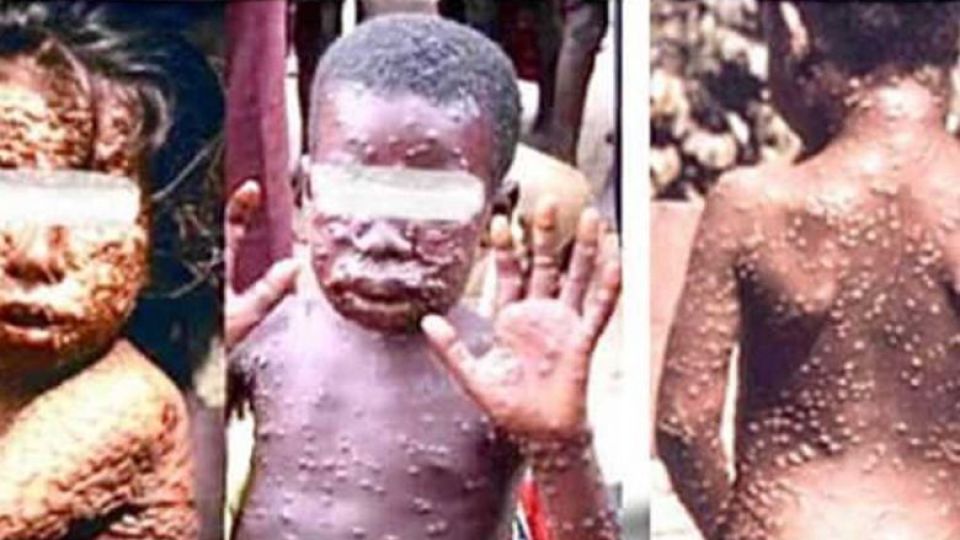 sample_photographs_of_monkeypox_symptoms_released_by_the_health_ministry._health_ministry.jpg